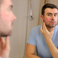 Understanding the Symptoms of Rosacea