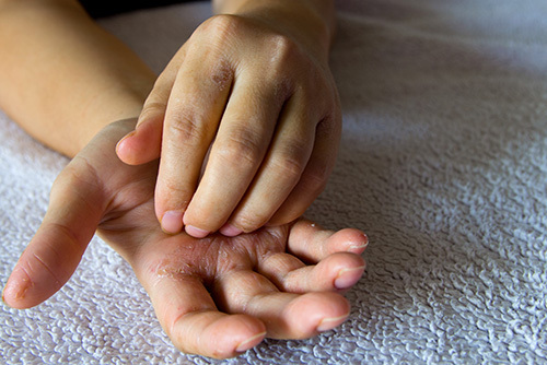 Person showing eczema signs by scratching their hand