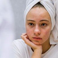 How Acne Impacts Mental Health