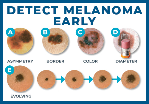ABCDEs of Skin Cancer diagram
