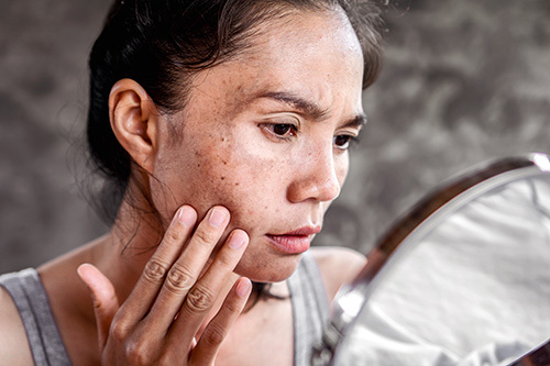 woman suffering from hyperpigmentation checking her skin in the mirror 