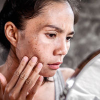 Hyperpigmentation and Melasma Awareness Month: What You Need To Know