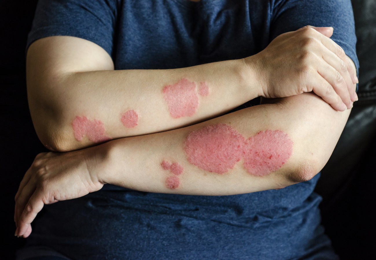 Man with psoriasis patches on both of his arms
